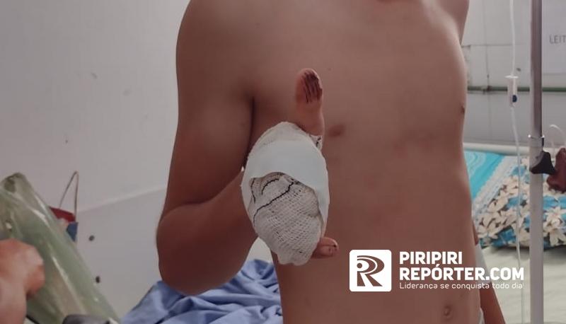 Garoto de 14 anos tem dedos decepados durante farinhada em Piripiri. Foto: Piripiri repórter Garoto de 14 anos tem dedos decepados durante farinhada em Piripiri. Foto: Piripiri repórter